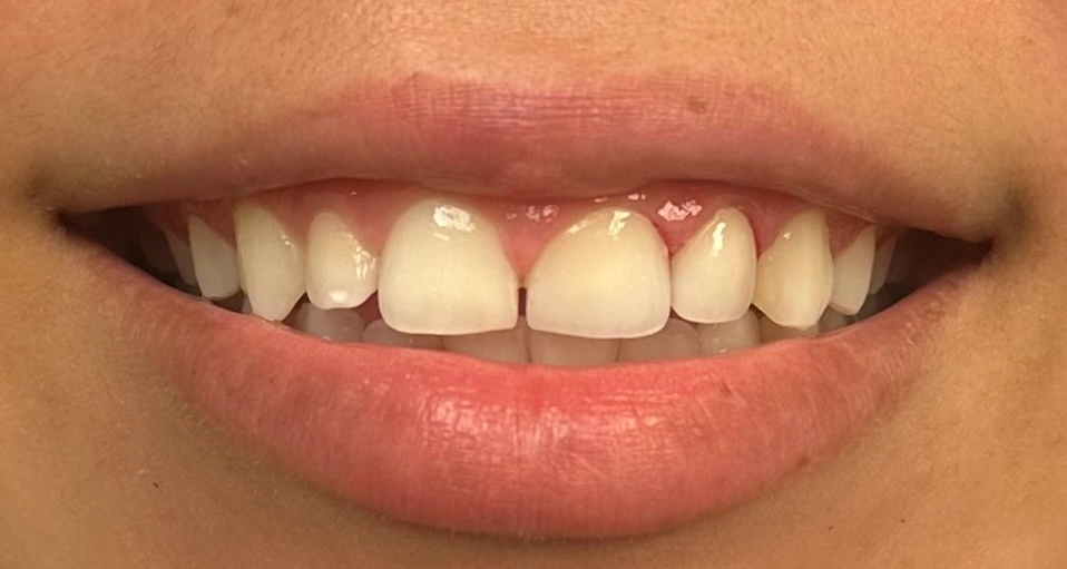 Emax Crown after smile