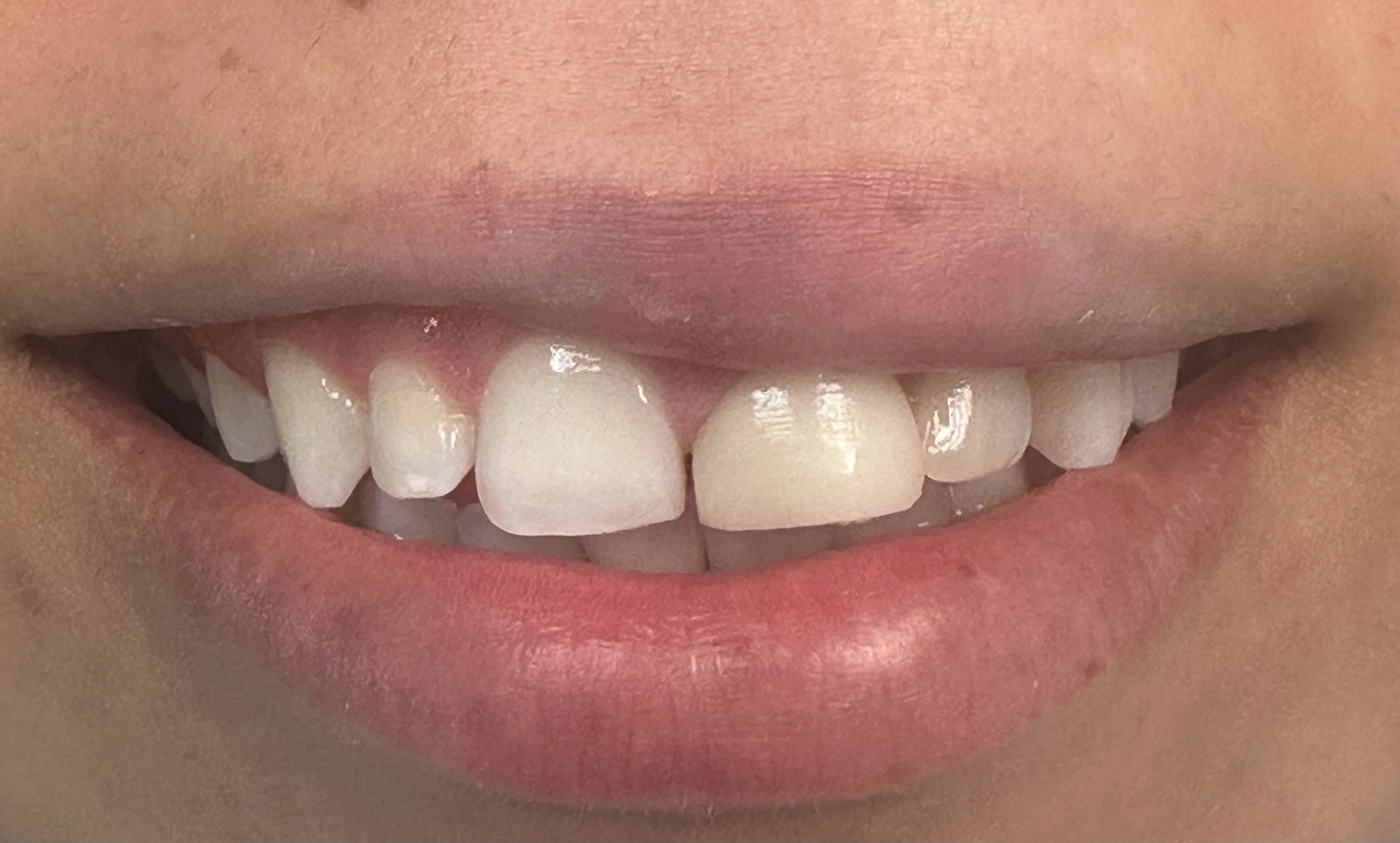 Emax Crown before smile