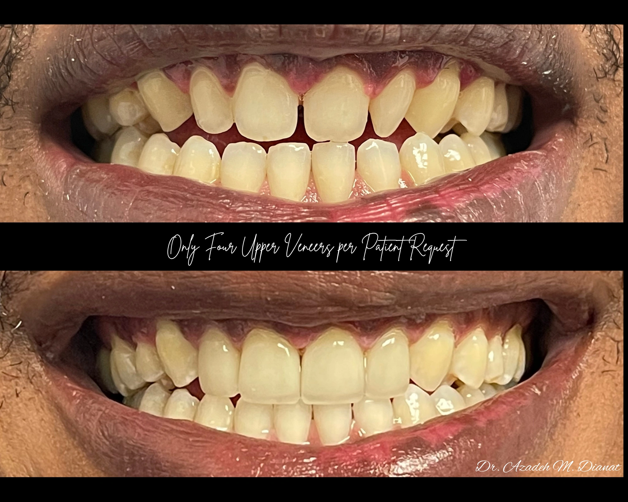 Smile makeover gallery result four