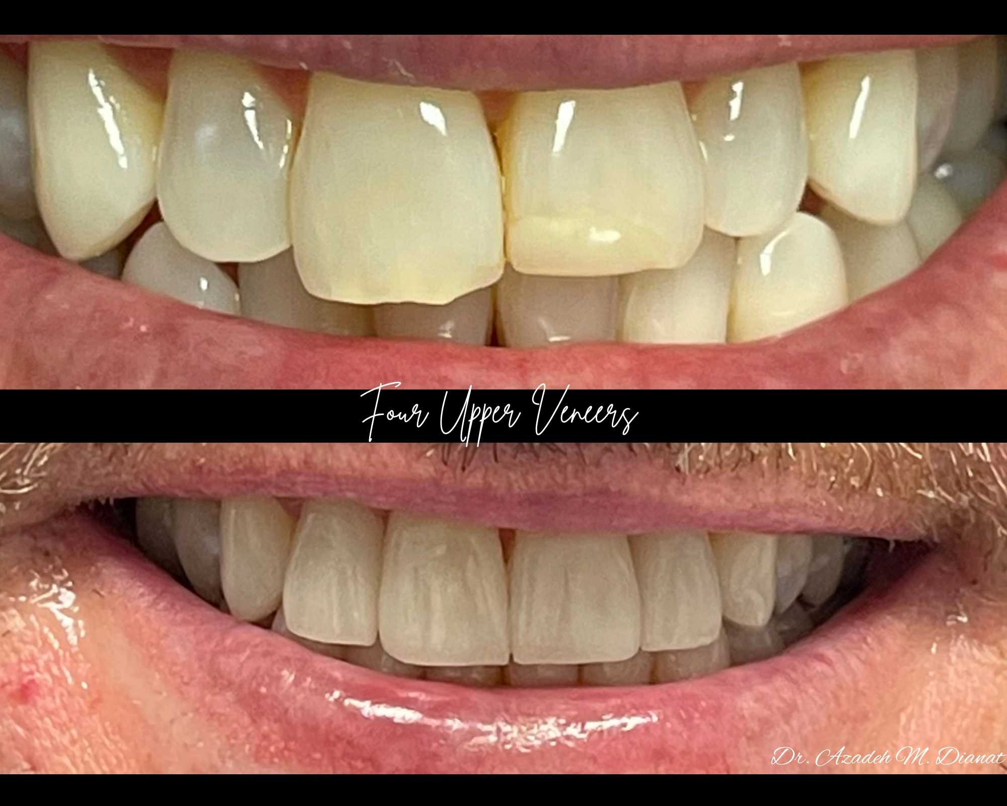 Smile makeover gallery result five