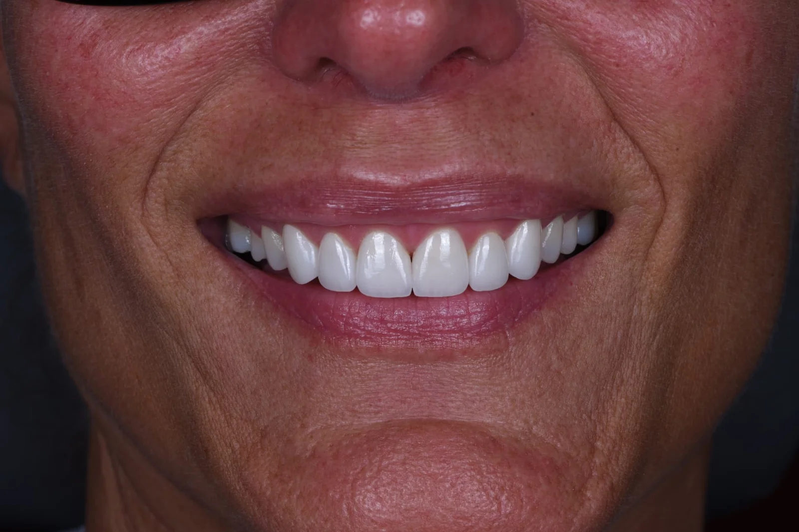 Invisalign, Veneers, and Implant Crown after smile, second case