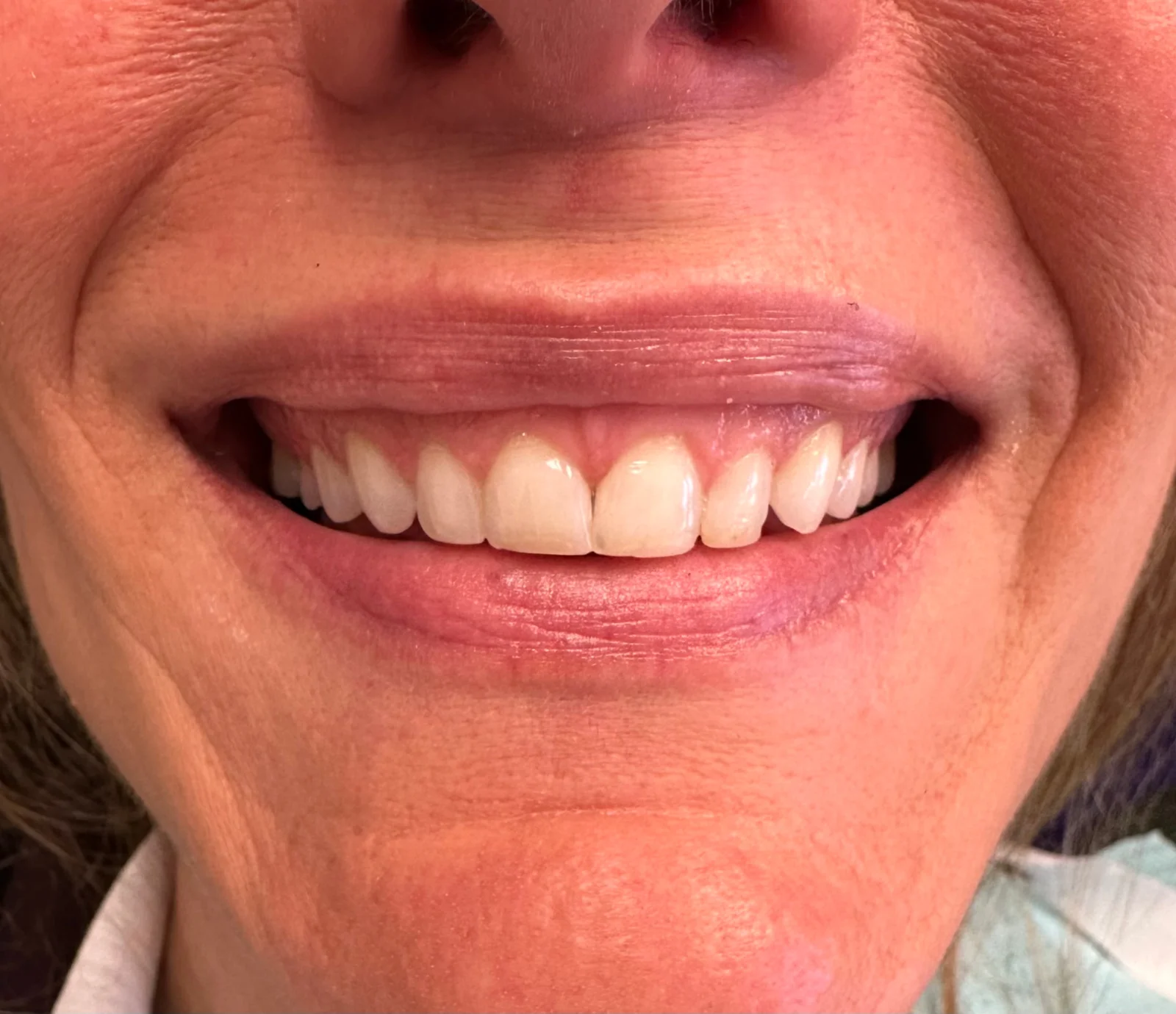 Invisalign, Veneers, and Implant Crown before smile, second case