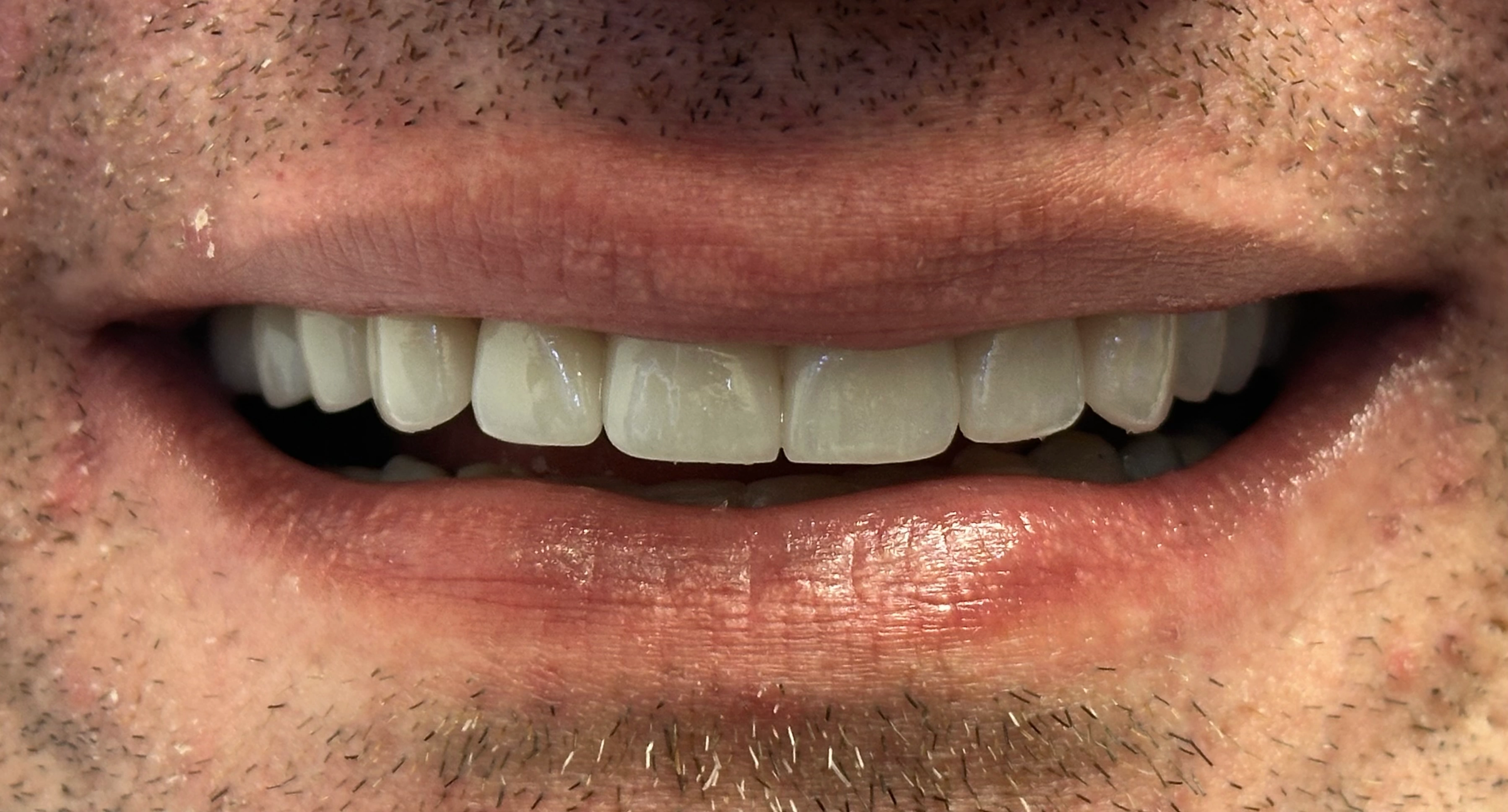 Invisalign, Veneers, and Implant Crown after smile
