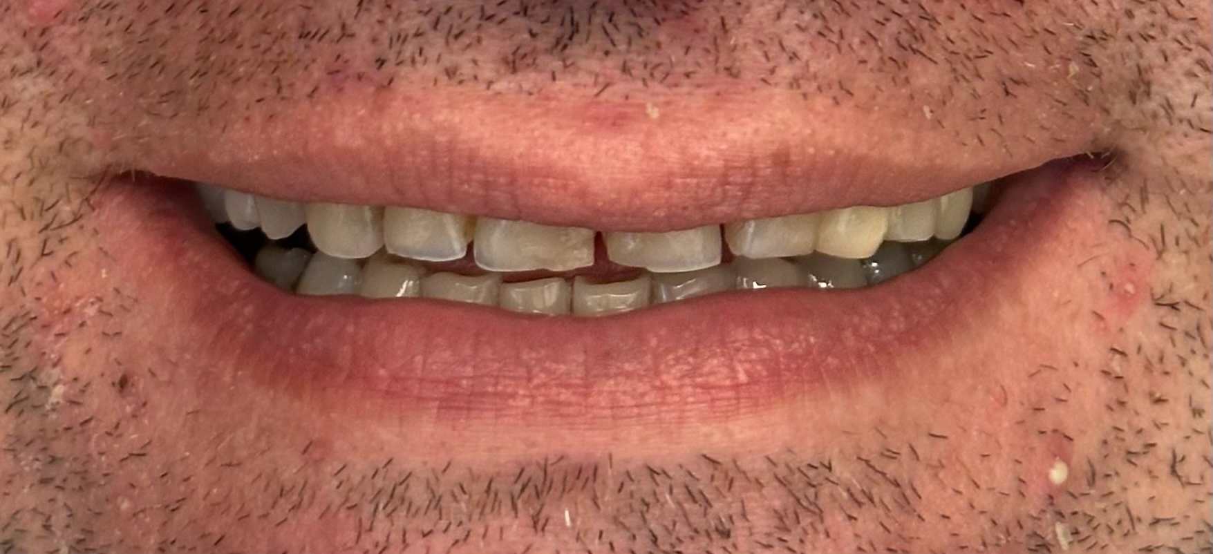 Invisalign, Veneers, and Implant Crown before smile