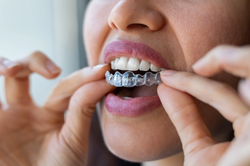 Patient placing a clear Invisalign aligner