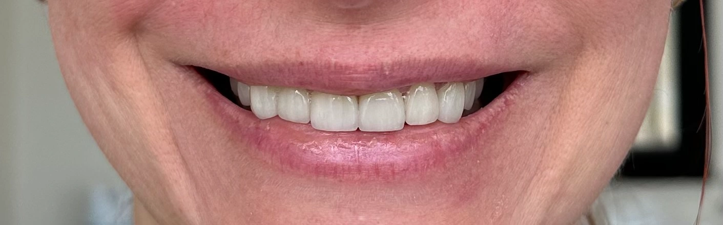 Veneers after photo