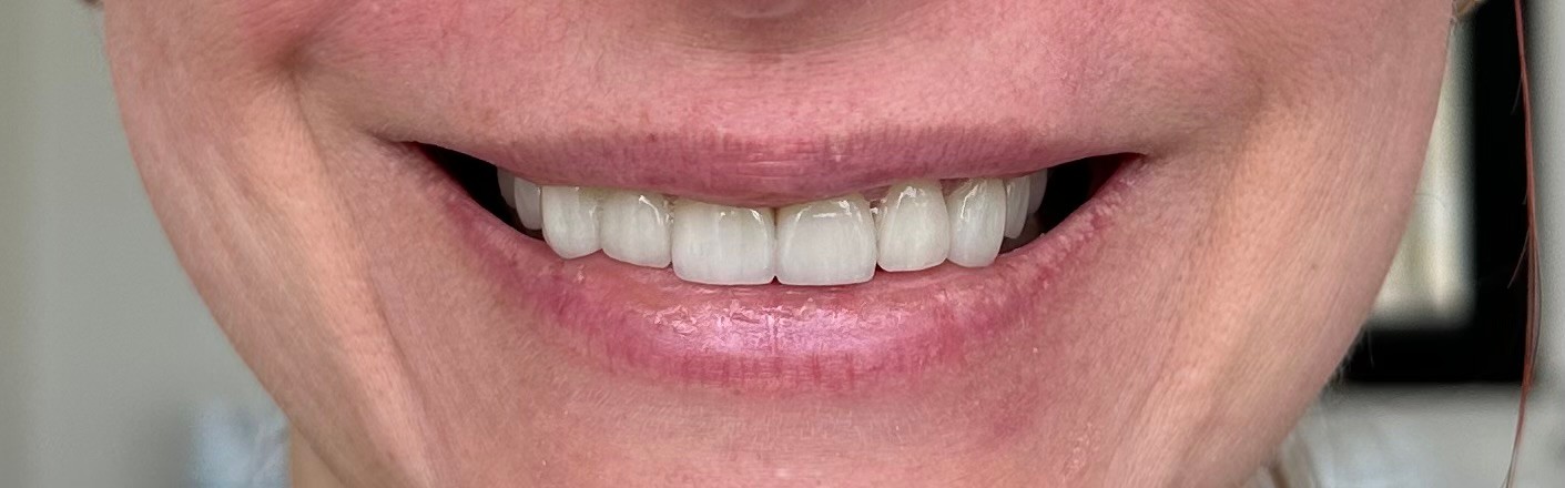 Veneers after smile makeover