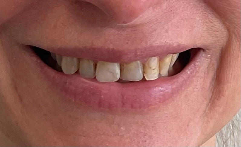 Veneers before photo